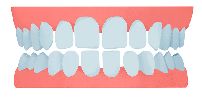 ruimte tussen tanden